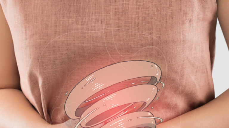 An Introduction To Irritable Bowel Syndrome